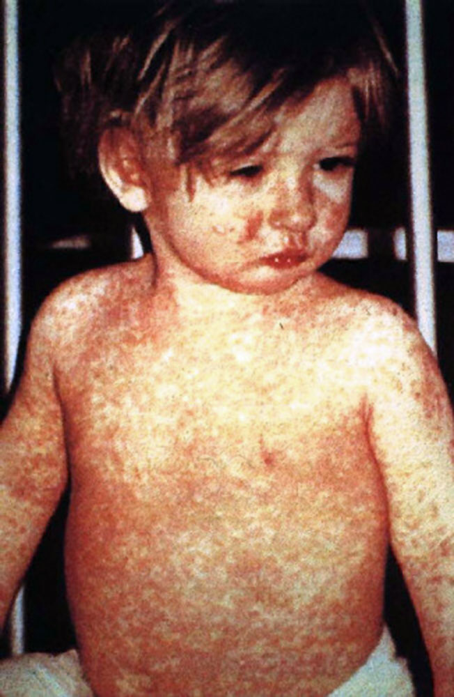 By CDC/NIP/Barbara Rice - http://phil.cdc.gov/phil/ (ID#: 132), Public Domain, https://commons.wikimedia.org/w/index.php?curid=210382
